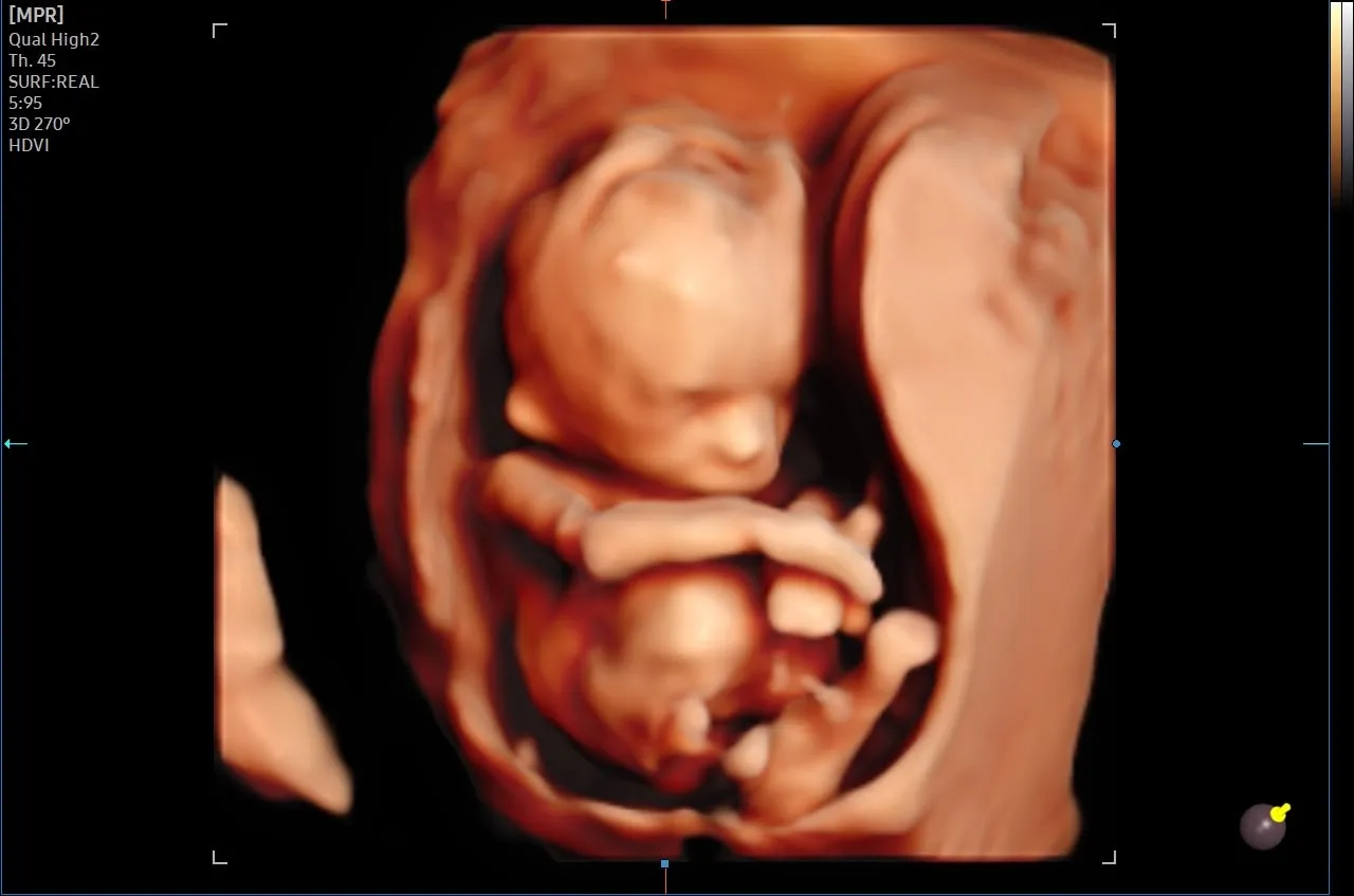 3D ultrasonda anne karnındaki bebeğin tüm vücudu