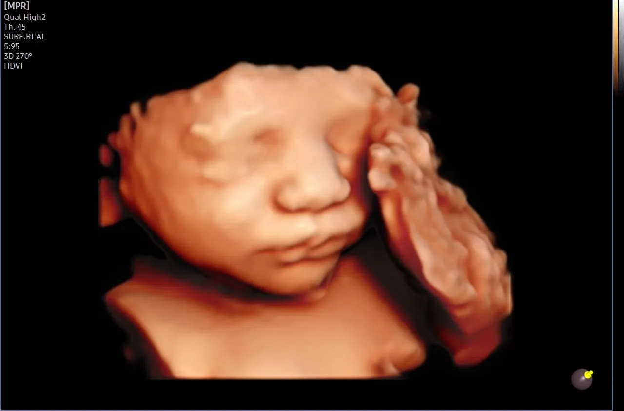 4D ultrasonda eli yanağında uyuyan bebek