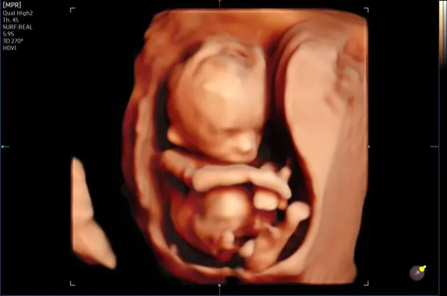 3D ultrasonda anne karnındaki bebeğin tüm vücudu