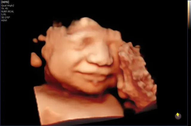 3D ultrasonda gülümseyen bebeğin yüzü